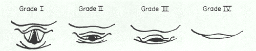 Cormack-Lehane Grades