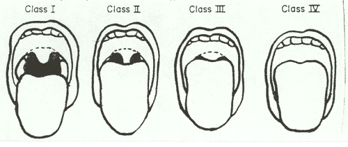 Mallampati Classes