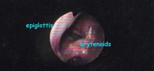 Fiberoptic View of Glottis