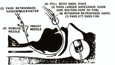 Retrograde Intubation Technic