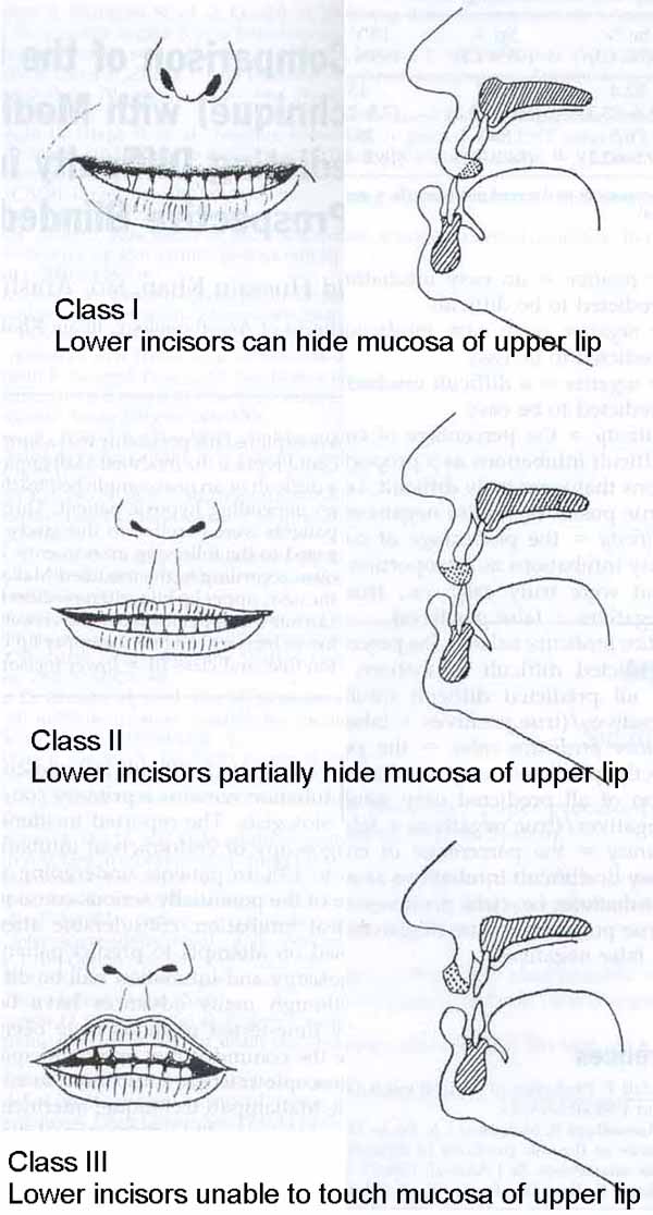 Upper Lip Bite Test